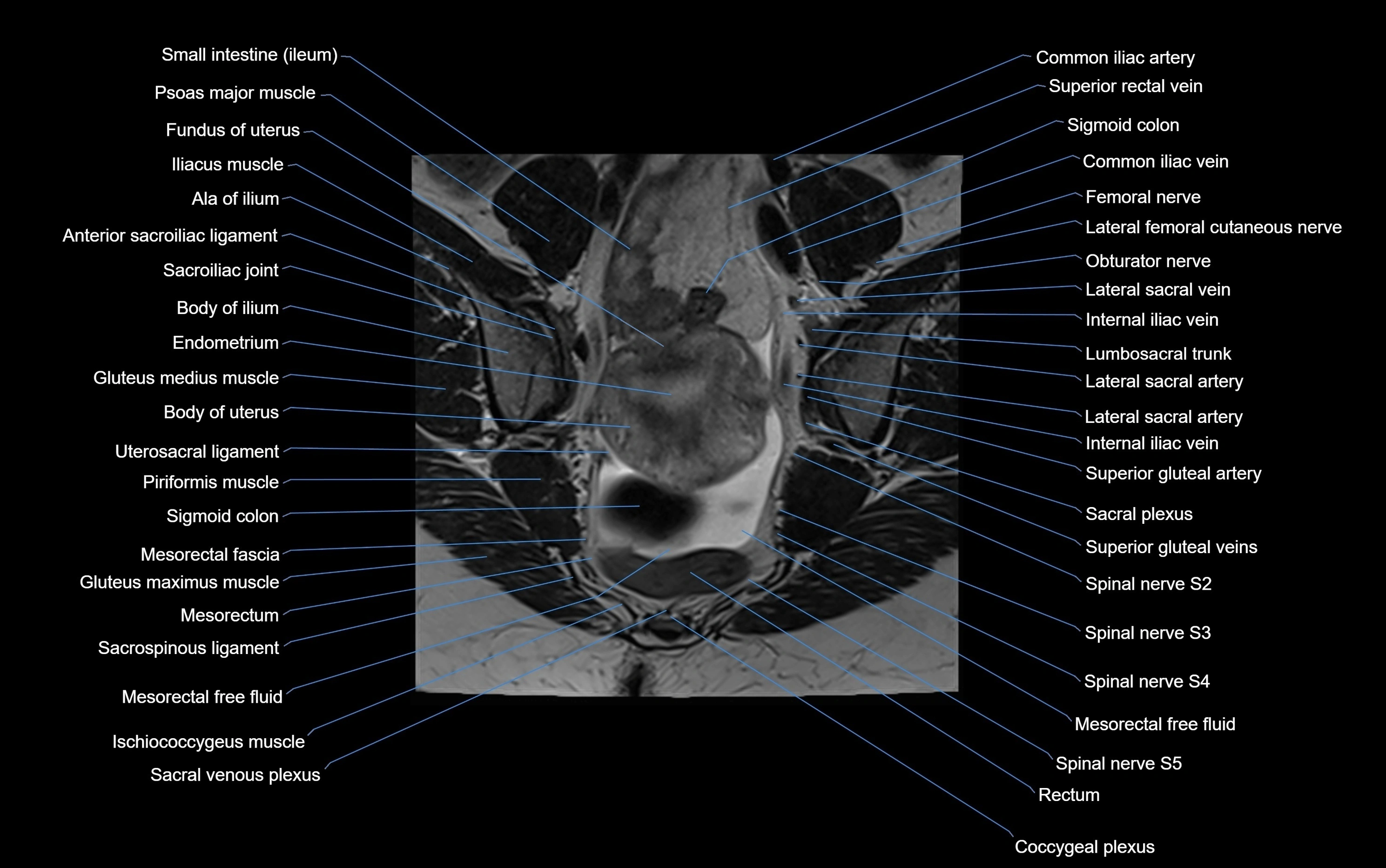 MRI sacroiliac joint coronal cross sectional anatomy  radiology  image-img-00001-00009.webp